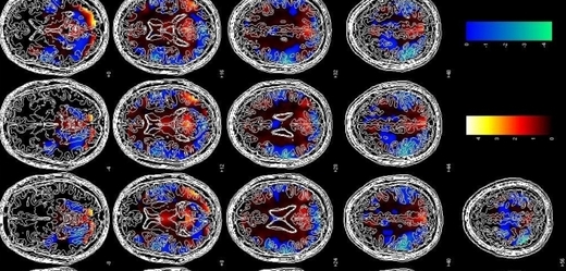 Statistická analýza výsledků skenování mozku (ilustrační foto).